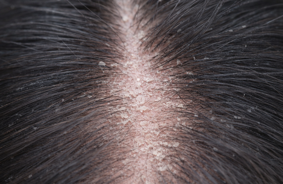 頭皮の乾燥が薄毛を進行させるメカニズム|町田のヘアサロンなら薄毛ケアに特化した＆Happily