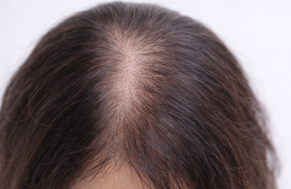女性特有のびまん性脱毛症とは？|町田のヘアサロンなら薄毛ケアに特化した＆Happily