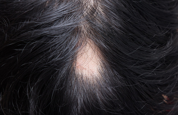 その薄毛、本当に遺伝だけ？|町田のヘアサロンなら薄毛ケアに特化した＆Happily